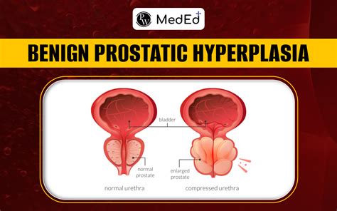 bphs sentral|Benign Prostatic Hyperplasia (BPH) .